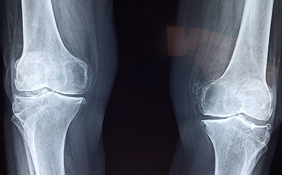 An x-ray of knees