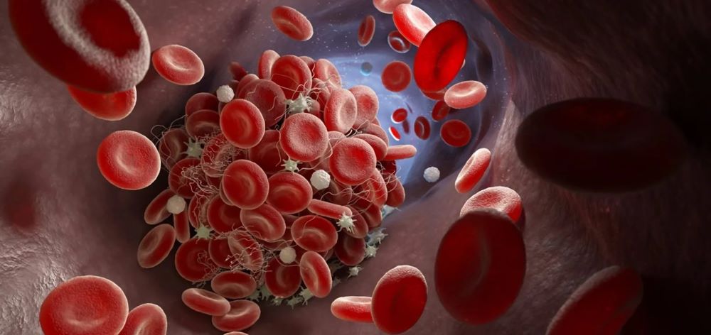 Blood clot image