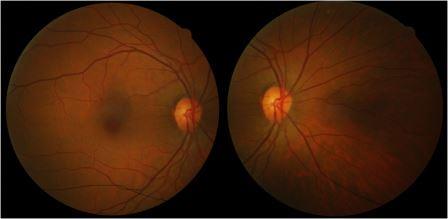 diabetic retinopathy