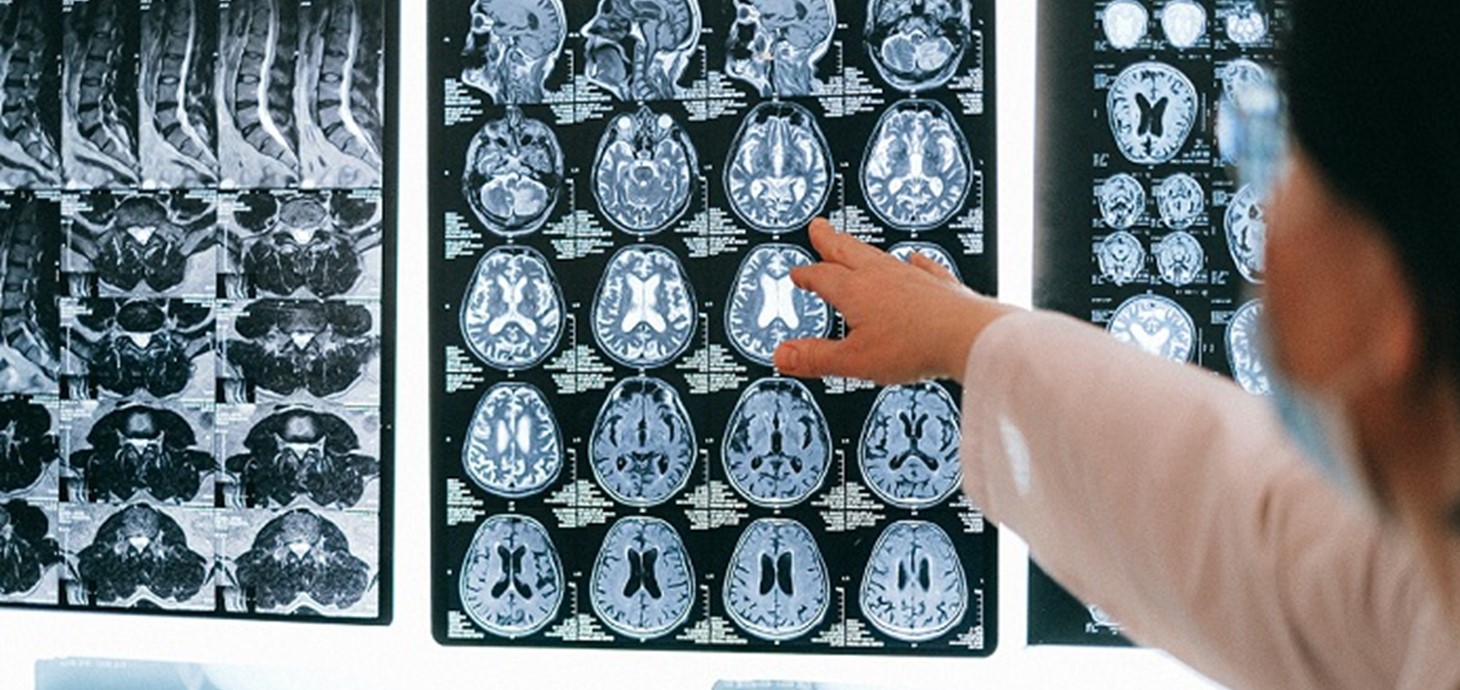 Brain scans. Epilepsy is a common condition affecting at least 600,000 people in the UK. The project team will use technology to study anonymised data that is already collected by healthcare professionals to improve and prioritise treatments.