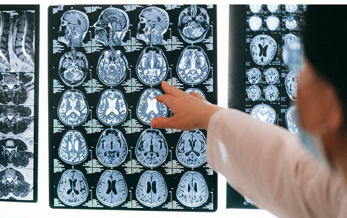 Brain scans. Epilepsy is a common condition affecting at least 600,000 people in the UK. The project team will use technology to study anonymised data that is already collected by healthcare professionals to improve and prioritise treatments.