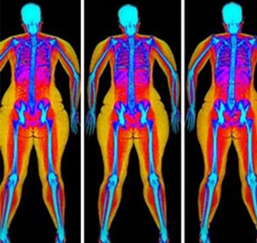 An x-ray image showing fat accumulation